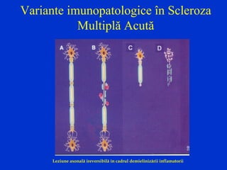 Variante imunopatologice în Scleroza
Multiplă Acută
Leziune axonală ireversibilă în cadrul demielinizării inflamatorii
 