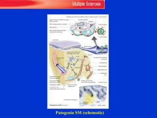 Patogenia SM (schematic)
221
Pathogenesis of MS (schematic)
Cerebral lesion (plaque)
Cerebral cortex
Antigen
Antigen peptides
Major histocompatibility complex
(MHC) protein
Macrophage
T-cell activation
Trimolecular interaction (MHC protein, antigen protein, T-cell receptor)
T-cell receptor
Activated T cell (ad-
hering to cell wall)
Crossing the blood-
brain barrier (BBB)
Autoreactive
T cell
Astrocyte
Endothelium (BBB)
Oligodendrocyte
Myelinated
axon
Neuron
Antigen-presenting cell
(microglia, astrocyte)
B cell
Antibody
Complement
Complement-activated
complexes
Demyelination
T-cell (TH1/TH2)
proliferation and activation
Blood vessel
MHC protein-bound peptide
(antigen presentation)
MHC/antigen protein complex
White matter
Lesion of myelin
sheath/axon
Antigen-presenting
cell in CNS (macrophage)
Multiple Sclerosis
Central
Nervous
System
Rohkamm, Color Atlas of Neurology © 2004 Thieme
All rights reserved. Usage subject to terms and conditions of license.
 