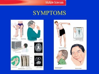 SYMPTOMS
219
Clinical findings
Special tests in MS (IEF = isoelectric focusing)
Impaired
coordination
Central paresis
(right hyperreflexia)
VEP measurement
MRI (T2-weighted image
of cerebral hemispheres)
MRI (T2-weighted
image of cerebellum)
Lumbar puncture IEF in MS IEF in normals
Oligoclonal bands
Serum
CSF
Lesions
Lesions
Ventricle
Multiple Sclerosis
Central
Nervous
System
Rohkamm, Color Atlas of Neurology © 2004 Thieme
217
Impaired coordination
Behavioral changes
Autonomic dysfunction
(urinary/fecal incontinence, sexual
dysfunction)
Paroxysmal symptoms
(trigeminal neuralgia)
Multiple Sclerosis
Central
Nervous
System
Rohkamm, Color Atlas of Neurology © 2004 Thieme
 