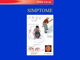 SIMPTOME
215
Sensory disturbances
Motor disturbances
(central paresis, spasticity,
abnormal fatigability)
Central scotoma (optic neuritis)
Dissociated nystagmus
(internuclear ophthalmoplegia,
patient looking to right)
Temporal papillary atrophy
(after optic neuritis)
Test for visual field defects (confrontation test)
Nystagmus of abducting eye
Adductor
paralysis
Atrophy
Multiple Sclerosis
Central
Nervous
System
Rohkamm, Color Atlas of Neurology © 2004 Thieme
All rights reserved. Usage subject to terms and conditions of license.
 