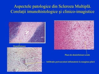 Aspectele patologice din Scleroza Multiplă.
Corelaţii imunohistologice şi clinico-imagistice
Microsc
opic
Demielinizare
Placă de demielinizare acută
Infiltraţie perivasculară inflamatorie la marginea plăcii
 