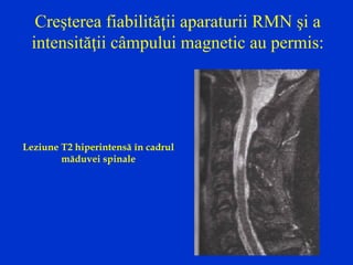 Creşterea fiabilităţii aparaturii RMN şi a
intensităţii câmpului magnetic au permis:
Leziune T2 hiperintensă în cadrul
măduvei spinale
 