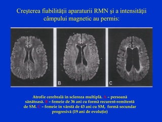 Creşterea fiabilităţii aparaturii RMN şi a intensităţii
câmpului magnetic au permis:
Atrofie cerebrală în scleroza multiplă. A – persoană
sănătoasă. B – femeie de 36 ani cu formă recurent-remitentă
de SM. C – femeie în vârstă de 43 ani cu SM, formă secundar
progresivă (19 ani de evoluţie)
 