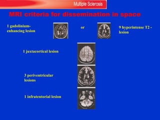 MRI criteria for dissemination in space
1 gadolinium-
enhancing lesion
or 9 hyperintense T2 -
lesion
1 juxtacortical lesion
3 periventricular
lesions
1 infratentorial lesion
 