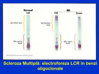 Scleroza Multiplă: electroforeza LCR în benzi
oligoclonale
 