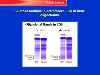 Scleroza Multiplă: electroforeza LCR în benzi
oligoclonale
 