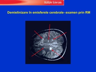 Demielinizare în emisferele cerebrale- examen prin RM
 