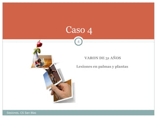 Caso 4
4

VARON DE 31 AÑOS
Lesiones en palmas y plantas

Sesiones, CS San Blas

 