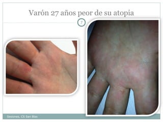 Varón 27 años peor de su atopia
7

Sesiones, CS San Blas

 