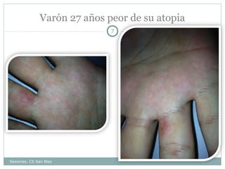 Varón 27 años peor de su atopia
7

Sesiones, CS San Blas

 