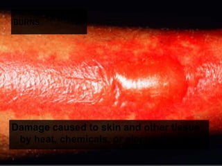 13 soft tissue_injuries