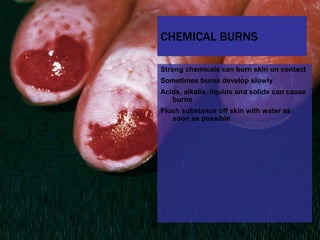 13 soft tissue_injuries