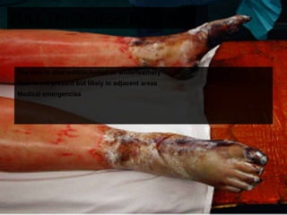 13 soft tissue_injuries