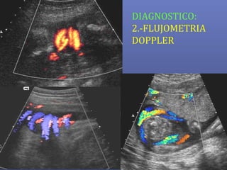 DIAGNOSTICO:
2.-FLUJOMETRIA
DOPPLER
 