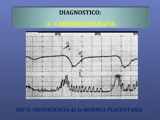 DIAGNOSTICO:
3.- CARDIOTOCOGRAFIA
DIP II: INSUFICIENCIA de la RESERVA PLACENTARIA
 