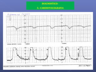 DIAGNOSTICO:
3.- CARDIOTOCOGRAFIA
 