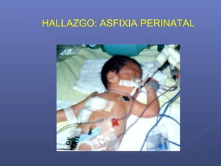 HALLAZGO: ASFIXIA PERINATAL
 
