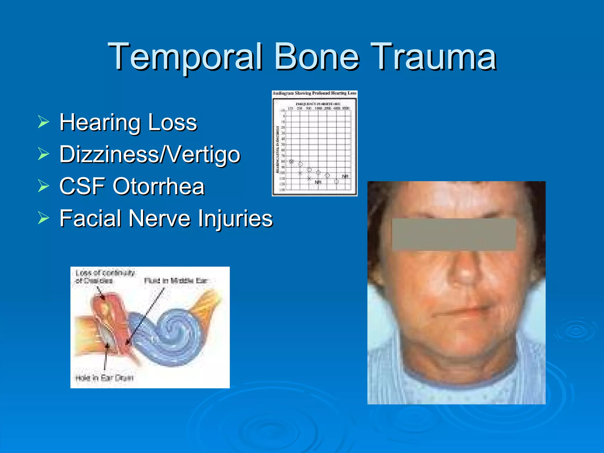 Temporal Bone Trauma Hearing Loss Dizziness/Vertigo CSF Otorrhea Facial Nerve Injuries 