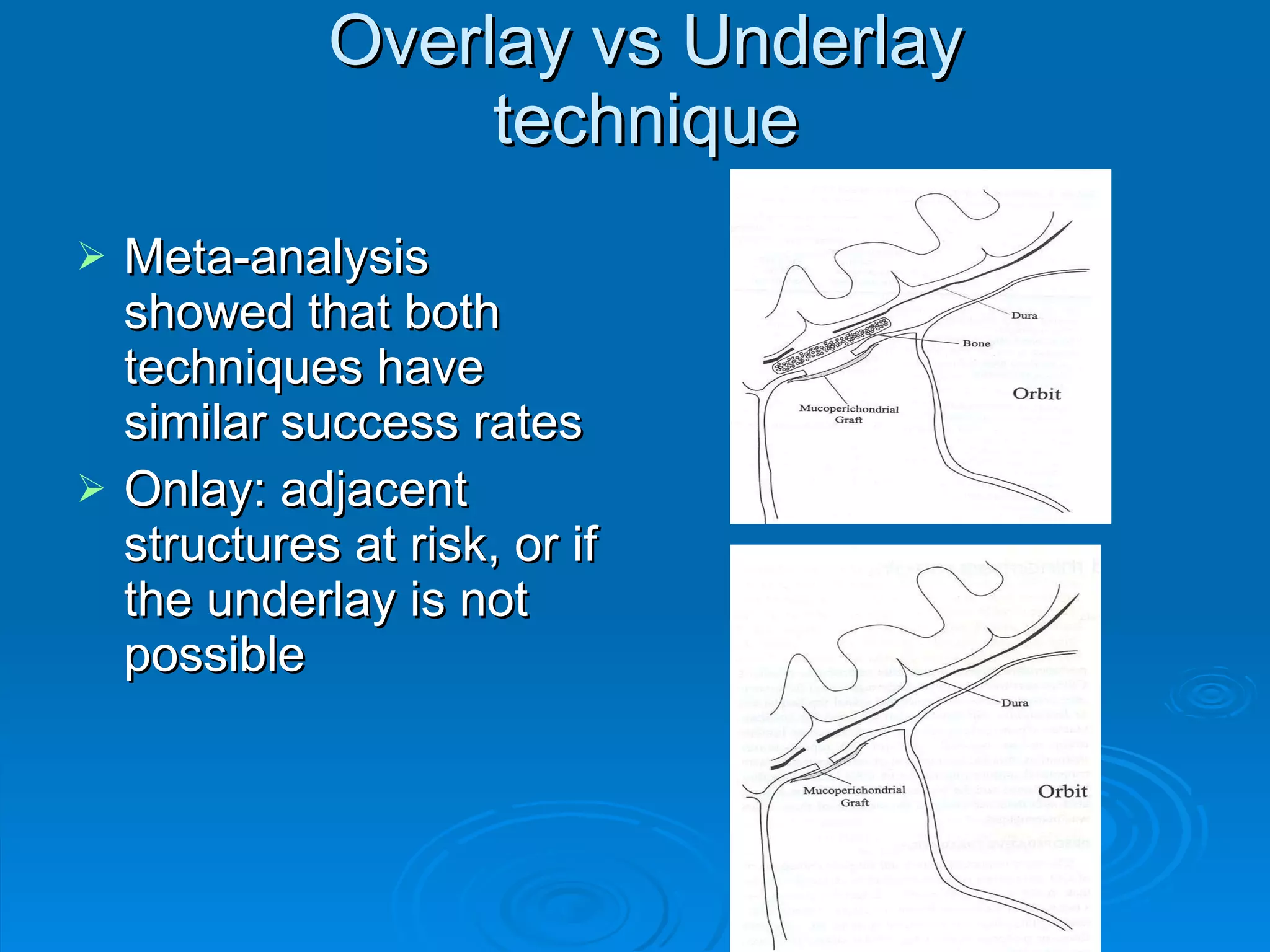Overlay vs Underlay technique Meta-analysis showed that both techniques have similar success rates Onlay: adjacent structures at risk, or if the underlay is not possible 