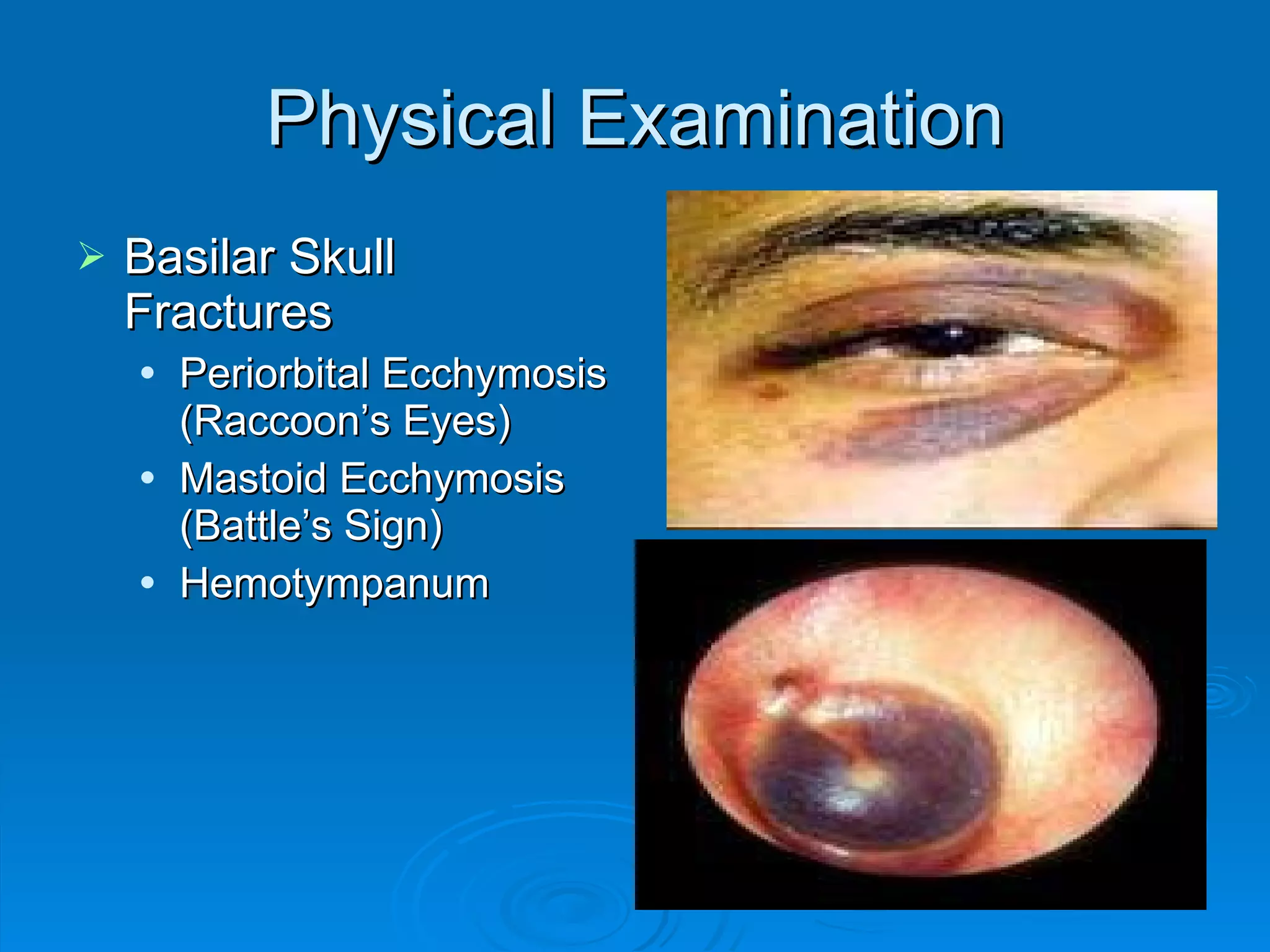 Physical Examination Basilar Skull Fractures Periorbital Ecchymosis (Raccoon’s Eyes) Mastoid Ecchymosis (Battle’s Sign) Hemotympanum 