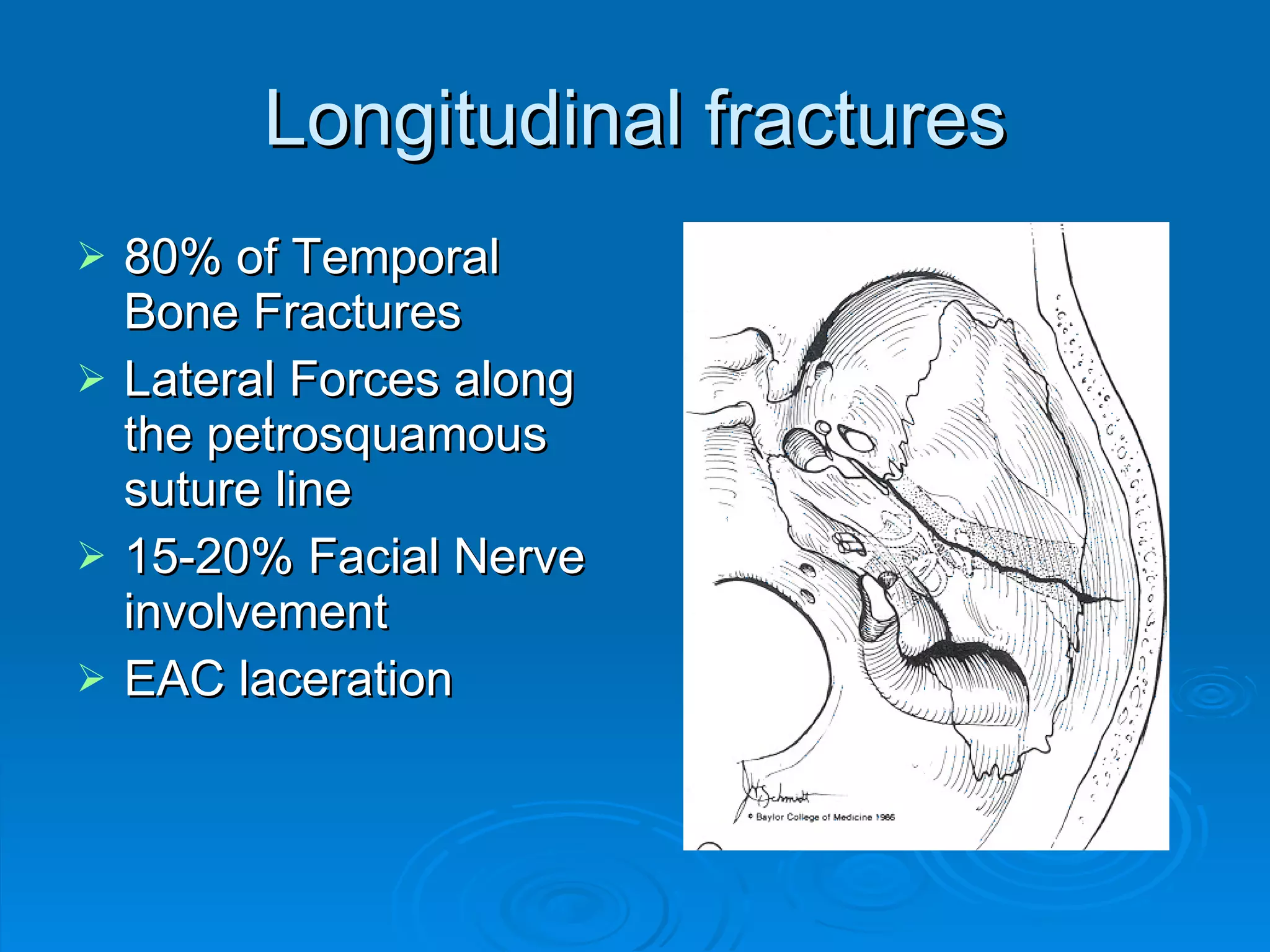 Longitudinal fractures 80% of Temporal Bone Fractures Lateral Forces along the petrosquamous suture line 15-20% Facial Nerve involvement EAC laceration 