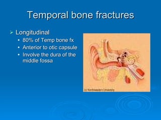 Temporal bone fractures Longitudinal 80% of Temp bone fx Anterior to otic capsule Involve the dura of the middle fossa 