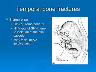 Temporal bone fractures Transverse 20% of Temp bone fx High rate of SNHL due to violation of the otic capsule 50% facial nerve involvement 