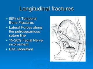 Longitudinal fractures 80% of Temporal Bone Fractures Lateral Forces along the petrosquamous suture line 15-20% Facial Nerve involvement EAC laceration 
