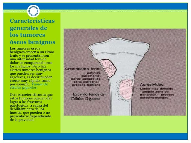 TUMORES OSEOS BENIGNOS PDF