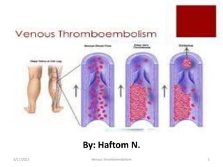 By: Haftom N.
5/17/2023 Venous thromboembolism 1
 