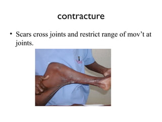 Scar Contraction 13 wound care power point presentation.pptx