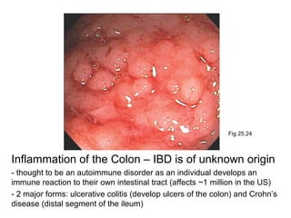 Fig 25.24

Inflammation of the Colon – IBD is of unknown origin
- thought to be an autoimmune disorder as an individual develops an
immune reaction to their own intestinal tract (affects ~1 million in the US)
- 2 major forms: ulcerative colitis (develop ulcers of the colon) and Crohn’s
disease (distal segment of the ileum)

 