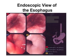 Endoscopic View of
the Esophagus

 