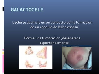 GALACTOCELE
Leche se acumula en un conducto por la formacion
de un coagulo de leche espesa
Forma una tumoracion ,desaparece
espontaneamente
 