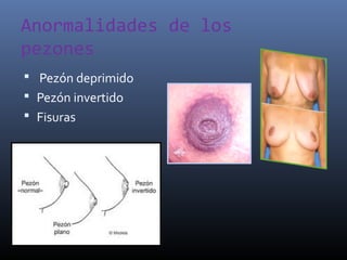Anormalidades de los
pezones
 Pezón deprimido
 Pezón invertido
 Fisuras
 