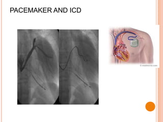 PACEMAKER AND ICD
 