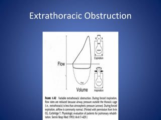 Extrathoracic Obstruction
 