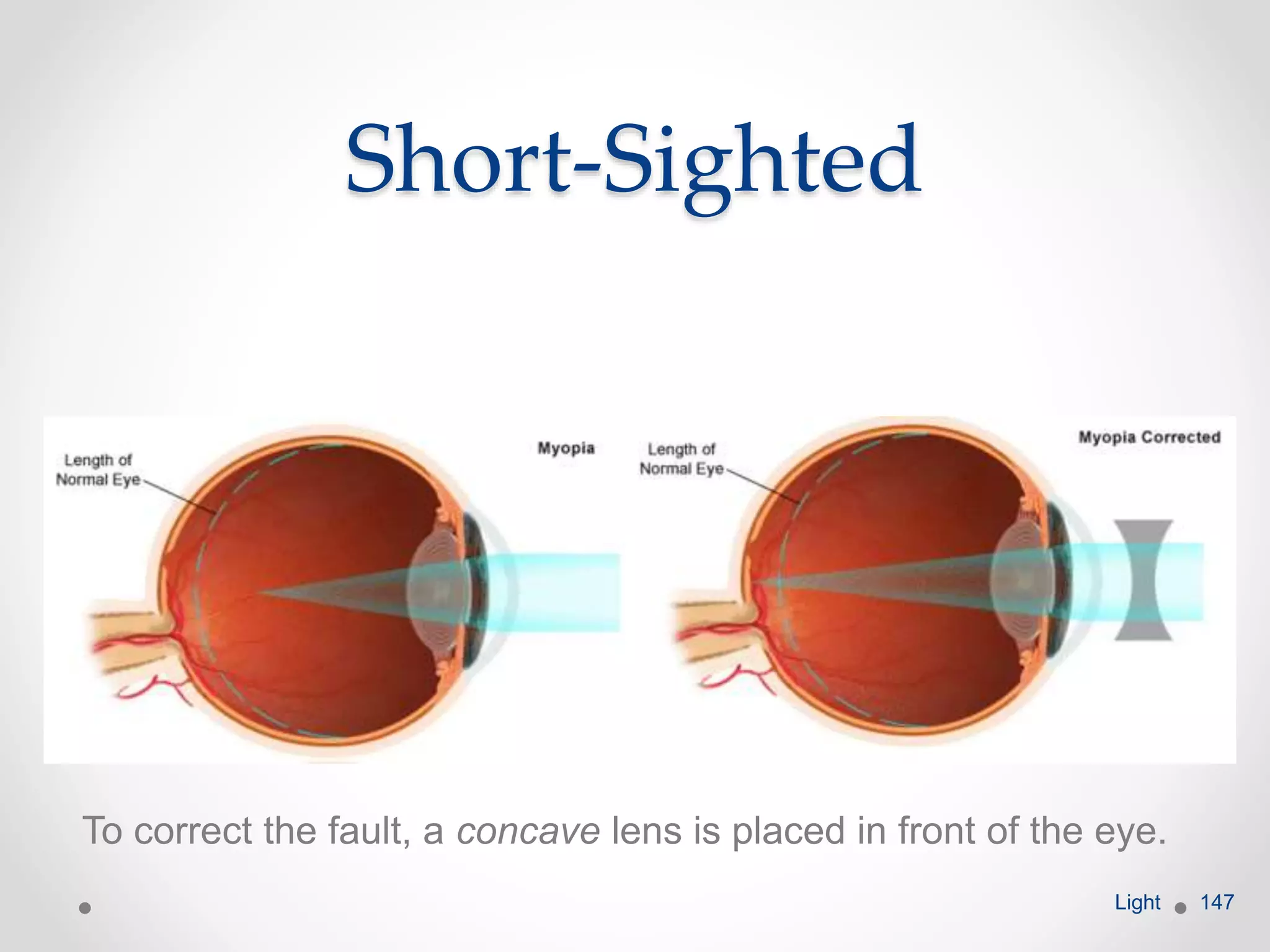 Short-Sighted
To correct the fault, a concave lens is placed in front of the eye.
Light 147
 