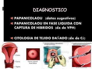PAPANICOLAOU (datos sugestivos)
PAPANICOLAOU EN FASE LIQUIDA CON
CAPTURA DE HIBRIDOS (dx de VPH)
CITOLOGIA DE TEJIDO DAÑADO (dx de Cá)
DIAGNOSTICO
 