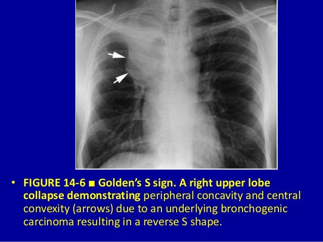 Pulmonary Lobar Collapsevessential Considerations 14 Dr Muhammad Bi