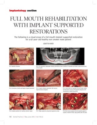 implantology section

FULL MOUTH REHABILITATION
WITH IMPLANT SUPPORTED
RESTORATIONS
The following is a visual essay of a full mouth implant supported restoration
for a 62- year- old healthy non smoker male patient
UDATTA KHER

FIG 1: Baseline situation

FIG 2: Pre-operative radiograph showing satisfactory bone condition in mandible and highly compromised bone
in the maxilla

FIG 3: Extraction of teeth and flapless implant placement

FIG 4: Flapless implant placement. Bio-horizon,
Tapered internal implants

FIG 5: Sinus graft for maxillary first left molar region
with Novabone (Calcium PhosphoSilicate)putty with
simultaneous implant placement

FIG 6: Implant positions for maxillary anterior region

FIG 7: Ridge expansion using bone expansion screws

FIG 8: Bio-horizon tapered internal implants placed in
sockets of teeth # 13,14,15. Gaps grafted with CPS putty

14 Dental Practice // May-June 2013 // Vol 11 No 6

 