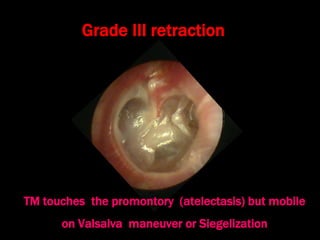 Grade III retraction
TM touches the promontory (atelectasis) but mobile
on Valsalva maneuver or Siegelization
 