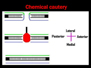 Chemical cautery
 