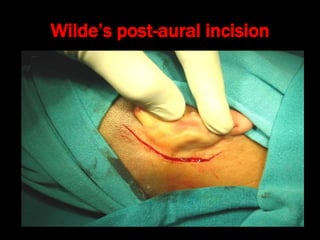Wilde’s post-aural incision
 