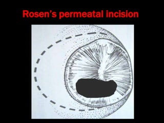 Rosen’s permeatal incision
 