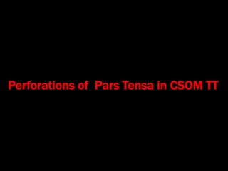 Perforations of Pars Tensa in CSOM TT
 