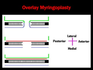 Overlay Myringoplasty
 