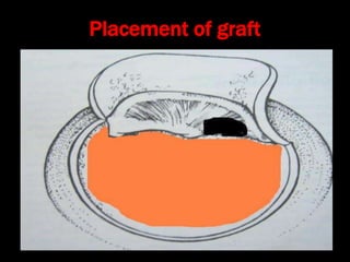 Placement of graft
 