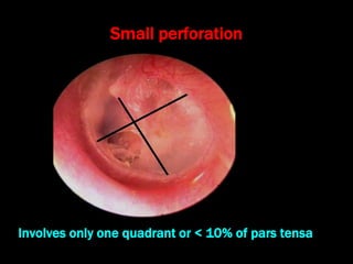 Involves only one quadrant or < 10% of pars tensa
Small perforation
 