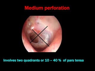 Medium perforation
Involves two quadrants or 10 – 40 % of pars tensa
 